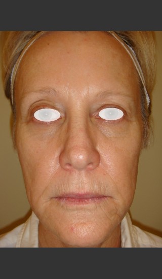 Before Photo for Rhytids (wrinkles) premature aging. - Christopher B. Zachary, MD - Prejuvenation