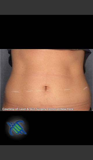 Before Photo for Treatment of Lower Abdomen with CoolSculpting - Roy G. Geronemus, M.D. - Prejuvenation