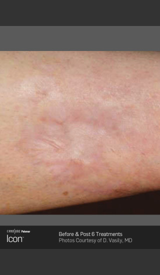 After Photo for Scar Reduction Using Icon 1540 -  - Prejuvenation