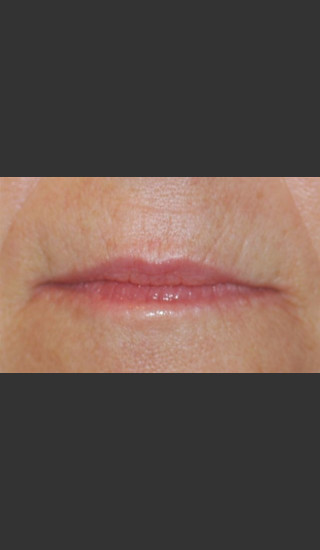 Before Photo for Treatment of Perioral Wrinkles - Roy G. Geronemus, M.D. - Prejuvenation