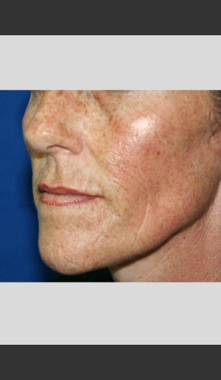 After Photo for elos for Color Correction -  - Prejuvenation