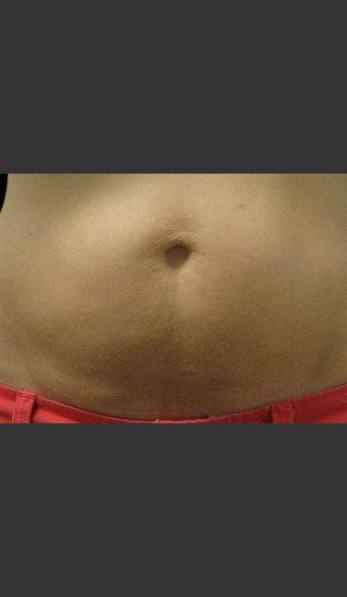 After Photo for Body Contouring Treatment #124 -  - Prejuvenation