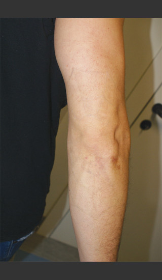 After Photo for Quanta Q-Plus C Laser Tattoo Removal #71 -  - Prejuvenation
