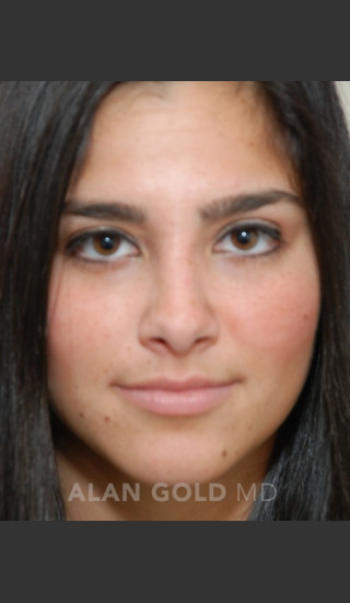 After Photo for Rhinoplasty 1676 - Alan Gold MD - Prejuvenation