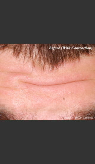 Before Photo for Treatment of Forehead Creases with Botox - Ron M. Shelton, M.D. - Prejuvenation
