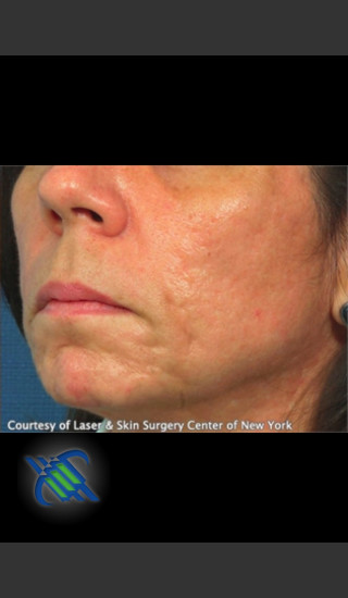 After Photo for Treatment of Lower Face Acne Scarring - Roy G. Geronemus, M.D. - Prejuvenation