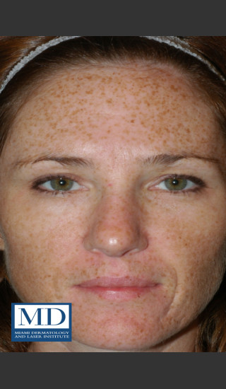 Before Photo for Photorejuvenation Treatment 110 - Jill S. Waibel, MD - Prejuvenation