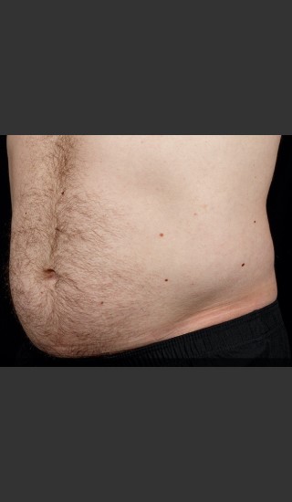 Before Photo for SculpSure Abdomen - Sean Doherty - Prejuvenation