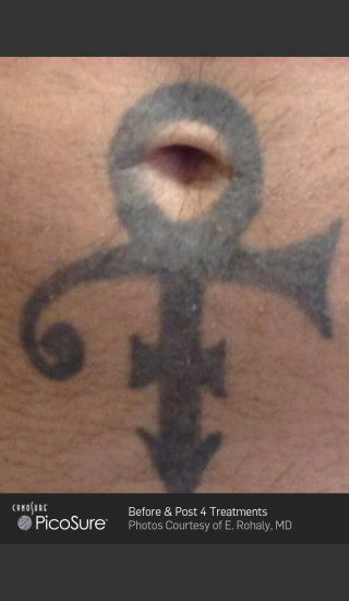 Before Photo for Tattoo Removal Before & After Photo of Cross -  - Prejuvenation