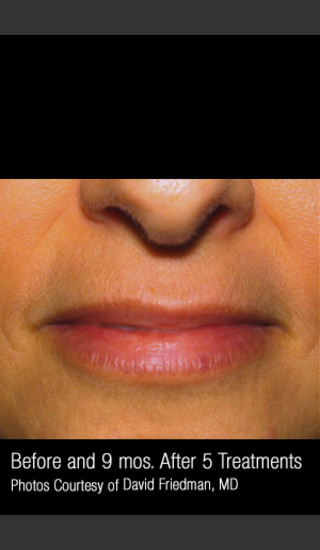 After Photo for Hair Removal #312 -  - Prejuvenation