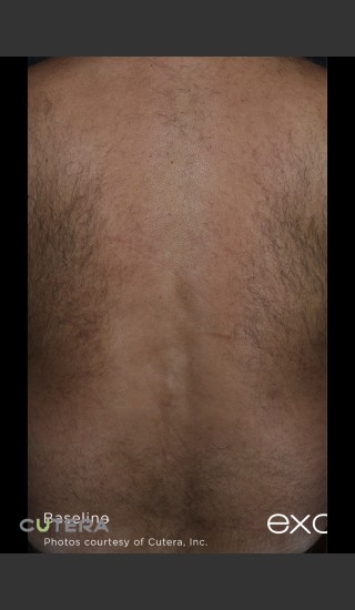 Before Photo for Hair Removal of Full Back With Excel HR -  - Prejuvenation