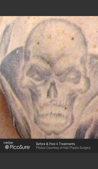 Before Photo for Tattoo Removal of Skull -  - Prejuvenation
