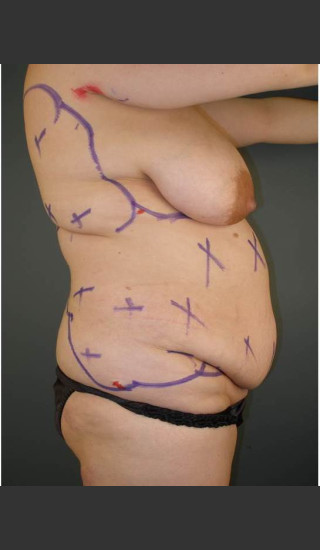 Before Photo for Liposuction #44 Side View - Dr. David Amron - Prejuvenation