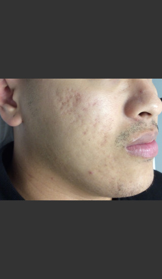 After Photo for Microneedling  - Janell Ocampo - Prejuvenation