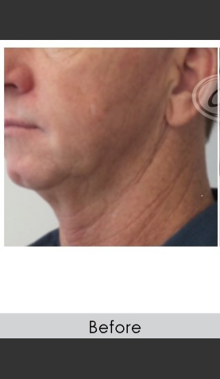 Before Photo for Male Jawline Enhancement with Radiesse - Annie Chiu, MD - Prejuvenation