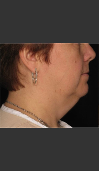 Before Photo for Treatment of Neck with Laser Liposuction -  - Prejuvenation
