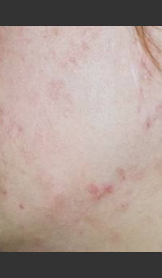 After Photo for Quanta Eterna IPL Acne Treatment #79 -  - Prejuvenation