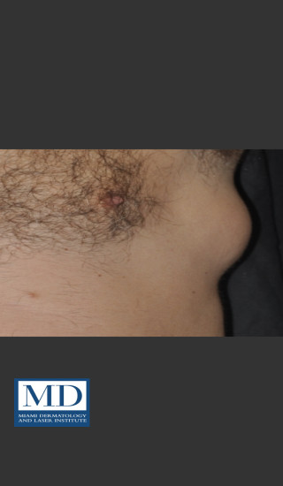 Before Photo for  Body Contouring Treatment 144 - Jill S. Waibel, MD - Prejuvenation