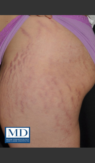 Before Photo for Striae Treatment 127 - Jill S. Waibel, MD - Prejuvenation