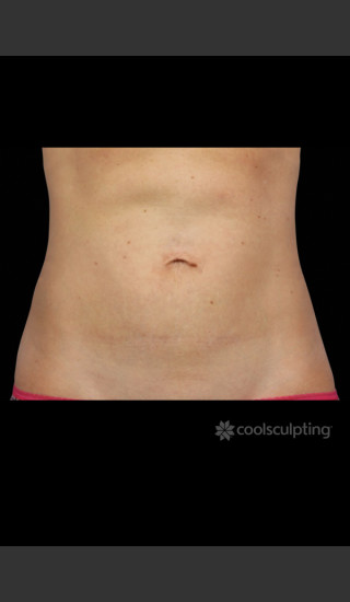 After Photo for CoolSculpting Woman's Abdomen and Flanks - W. Grant Stevens, MD, FACS - Prejuvenation