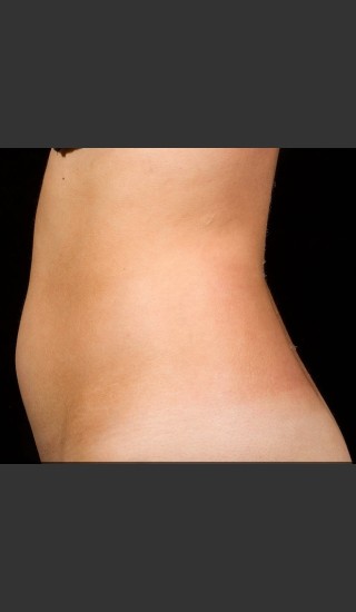 Before Photo for SculpSure Abdomen - Bruce E Katz, M.D. - Prejuvenation