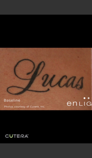 Before Photo for Tattoo Removal Before & After Photo 