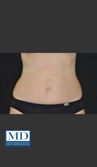 After Photo for  Body Contouring Treatment 142 - Jill S. Waibel, MD - Prejuvenation