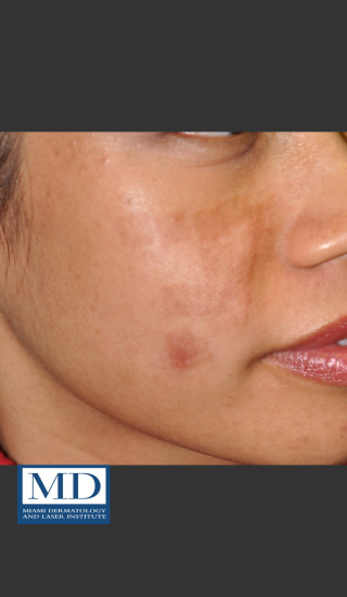 Before Photo for Post Inflammatory Hyperpigmentation 119 - Jill S. Waibel, MD - Prejuvenation