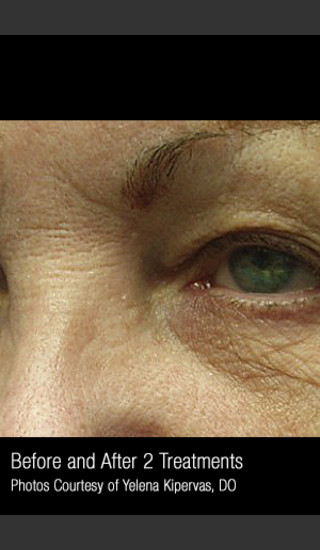 After Photo for Treatment of Facial Pigmentation #330 -  - Prejuvenation