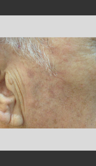 After Photo for Elos - Facial Contouring & Wrinkles -  - Prejuvenation