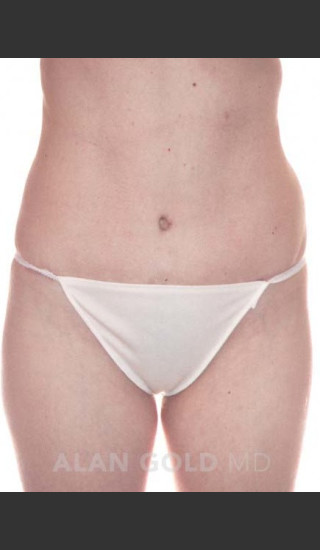 After Photo for Abdominoplasty 286 - Alan Gold MD - Prejuvenation