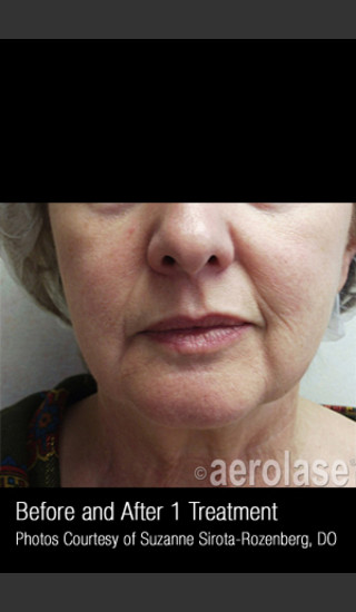 Before Photo for Skin Tightening #342 -  - Prejuvenation