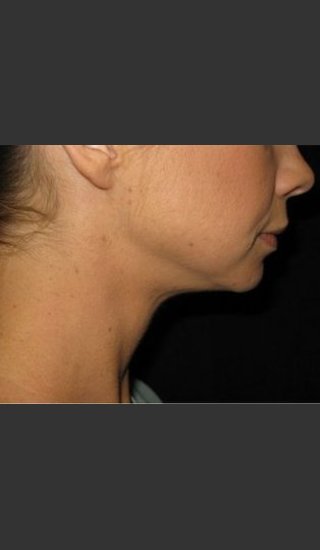 After Photo for Laser Asissted Liposuction - Robert Aycock - Prejuvenation