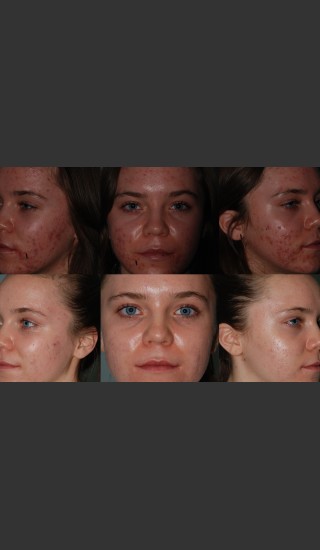 Before Photo for Laser Treatment of Acne - Mark B. Taylor, M.D. - Prejuvenation