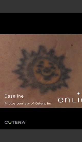 Before Photo for Tattoo Removal Before & After Photo of Sun -  - Prejuvenation