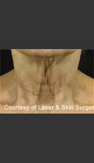 Before Photo for Treatment of Fine lines and Wrinkles -  - Prejuvenation