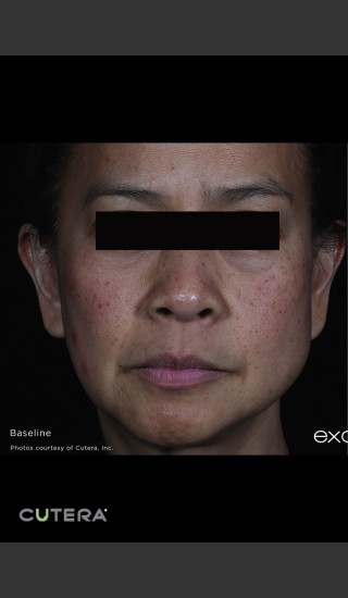 Before Photo for Pigmented Removal Before & After Photo Front On Full Face -  - Prejuvenation