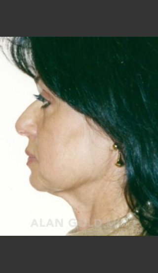 Before Photo for Rhytidectomy (Facelift) 1884 Side View - Alan Gold MD - Prejuvenation