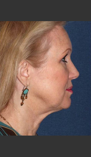 After Photo for Non-invasive Chin Contouring - Dr. Sabrina G. Fabi - Prejuvenation