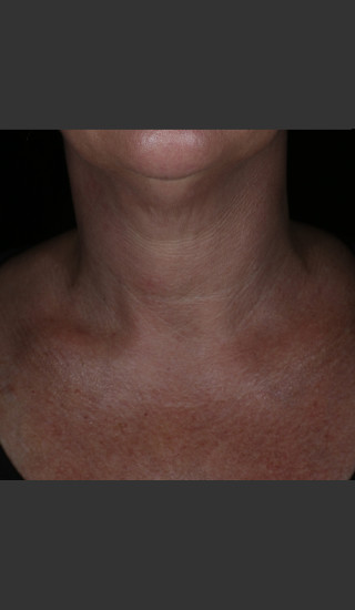 Before Photo for Alastin Skincare Restorative Neck Complex with TriHex Technology® -  - Prejuvenation