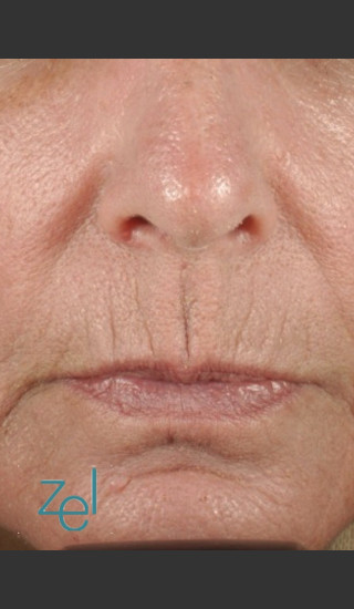 Before Photo for Treatment of Peri-Oral Lines and Wrinkles - Brian D. Zelickson, M.D. - Prejuvenation