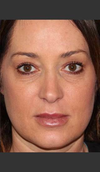 After Photo for Lip Augmentation - Douglas Wu, M.D. - Prejuvenation