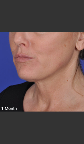 After Photo for ThermiTight Treatment - Barry E. DiBernardo, MD, FACS - Prejuvenation