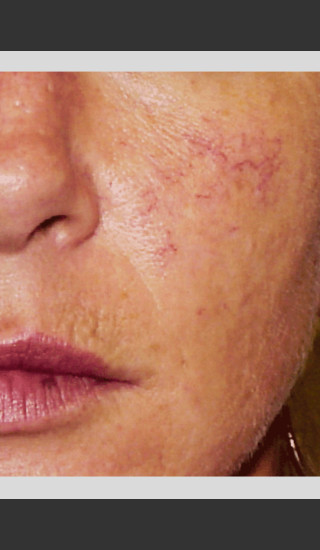 Before Photo for Vbeam Pulsed Dye Laser treatment of Rosacea -  - Prejuvenation