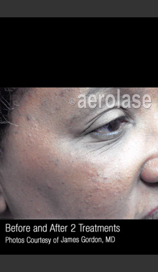 After Photo for Facial Pigmentation & Texture #325 -  - Prejuvenation