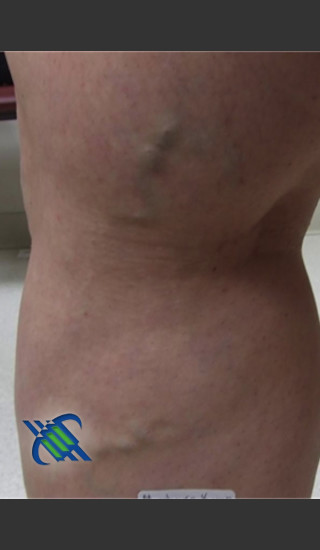 Before Photo for Treatment of Leg Veins - Roy G. Geronemus, M.D. - Prejuvenation
