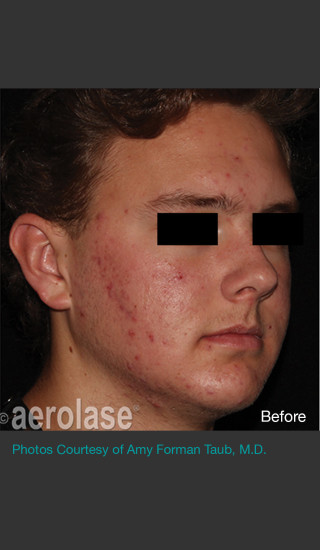 Before Photo for NeoClear by Aerolase Acne Treatment - Amy Forman Taub, MD - Prejuvenation