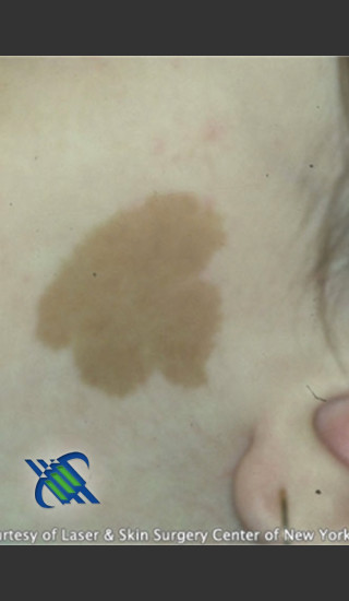 Before Photo for Treatment of Facial  Caf_ au Lait - Roy G. Geronemus, M.D. - Prejuvenation