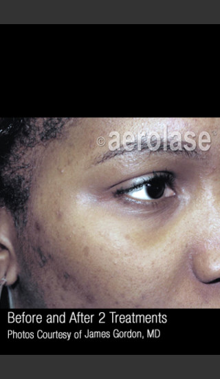 Before Photo for Facial Pigmentation & Texture #326 -  - Prejuvenation