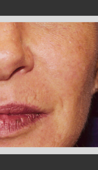 After Photo for Vbeam Pulsed Dye Laser treatment of Rosacea -  - Prejuvenation
